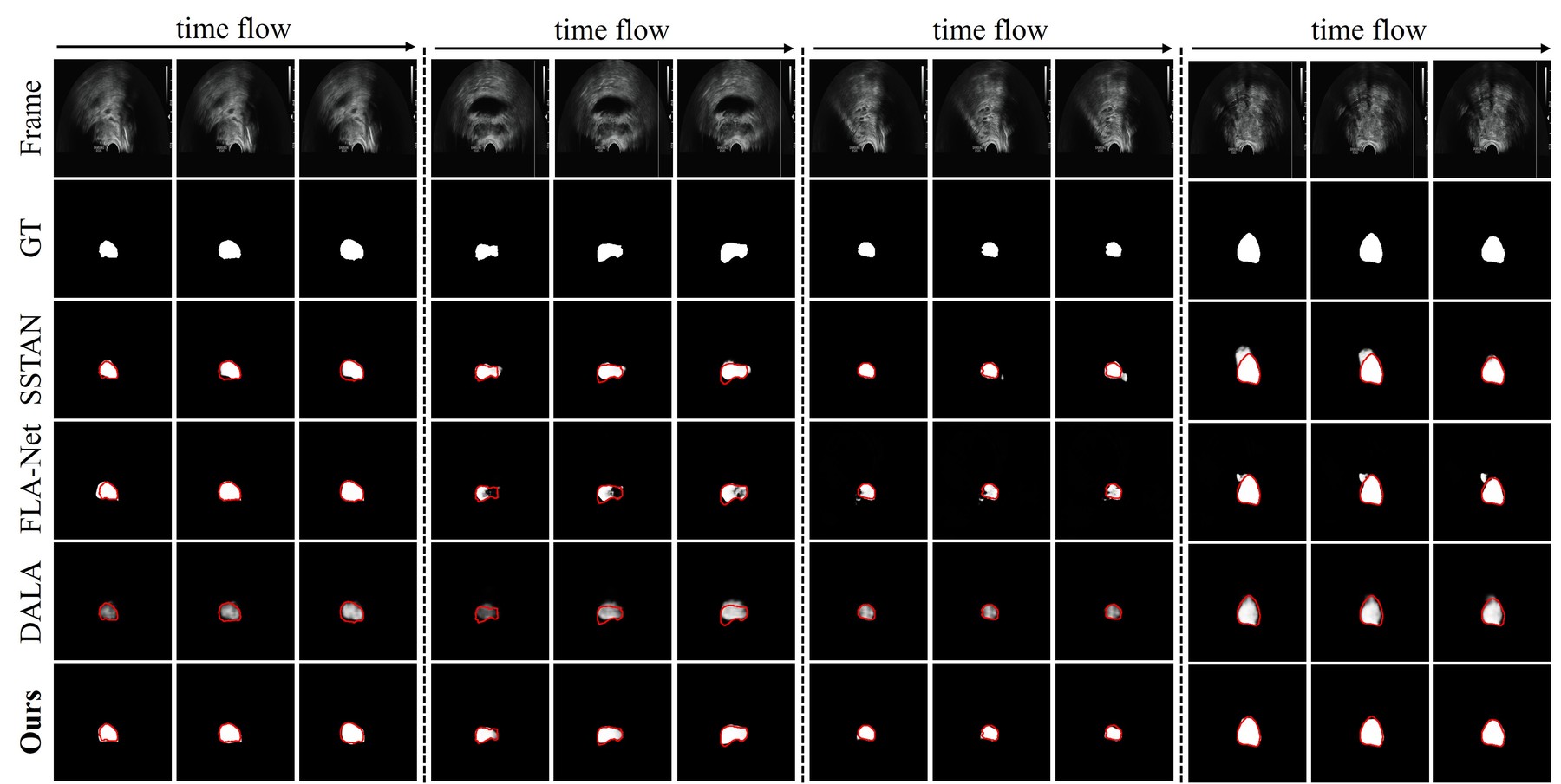 Visual comparison on TRUS-V across frames, ground truth, competing methods, and DTC-TRUS results.