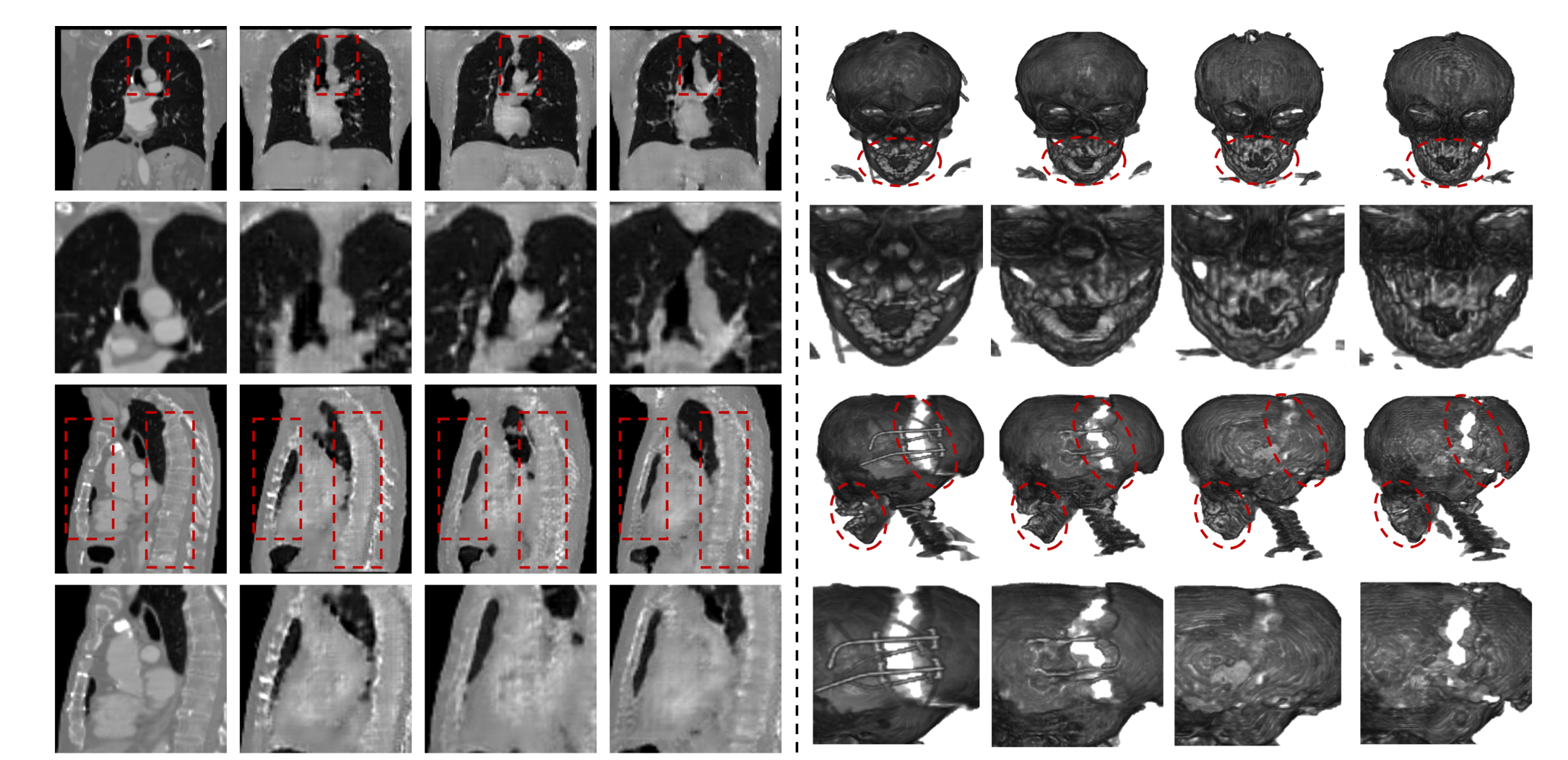 Qualitative comparison of PSCT-Net, TRCT-GAN, and X2CT-GAN reconstructions